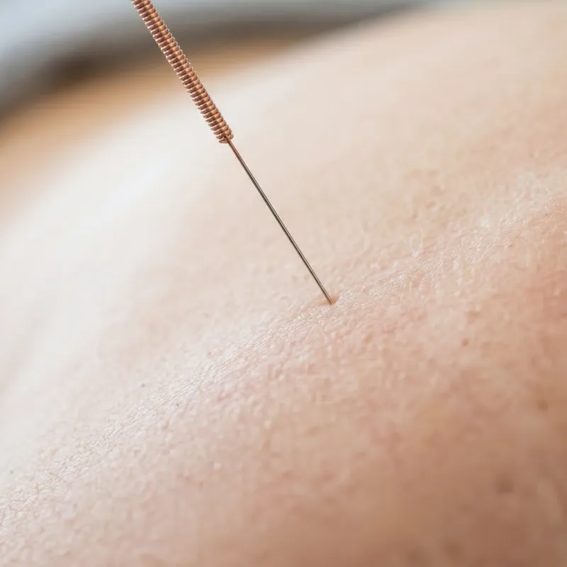 Dry Needling Therapy